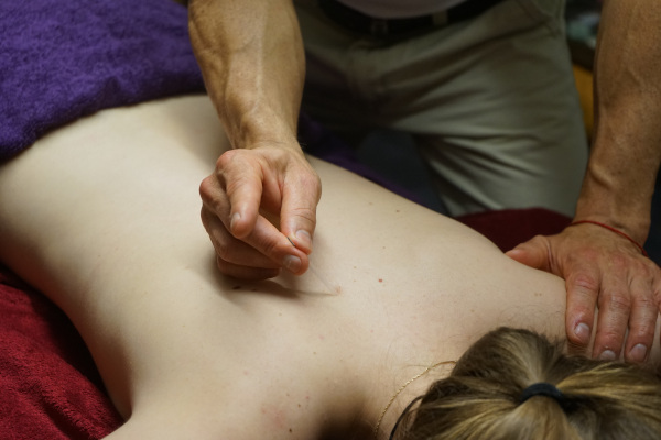 Acupunture